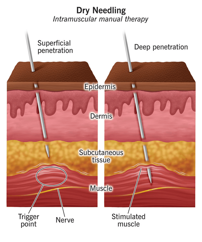 Physiotherapist performing dry needling on a patient's back